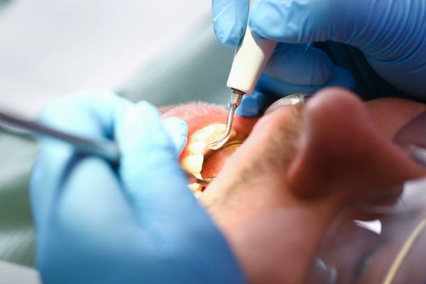 Best Emergency Root Canal Treatment in Moodys, OK